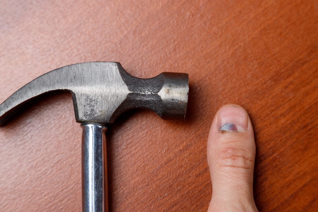 Bruised thumb nail after small accident with a hammer