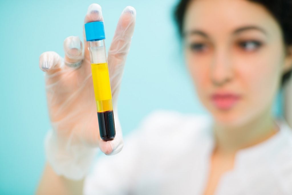 Woman holding yellow blood plasma in a glass test tube